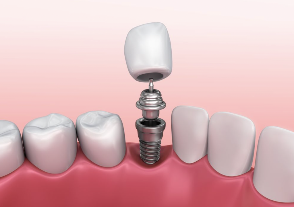 A Brief History of Dental Implants A Brief History of Dental Implants