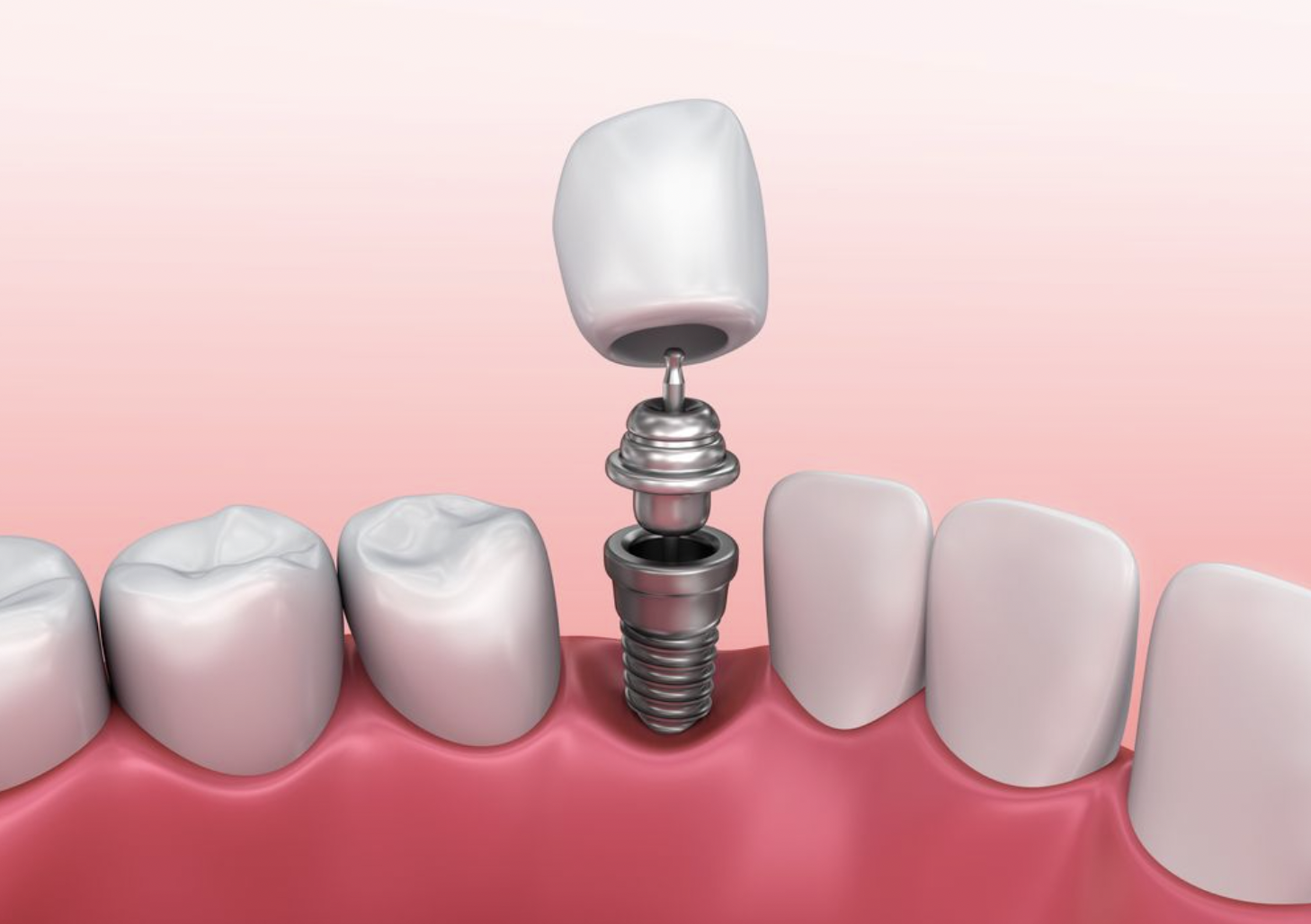 A Brief History of Dental Implants | ZXQ