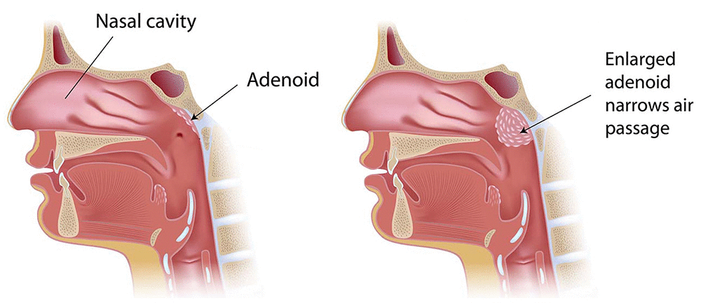 Adenoidectomy | healthdirect