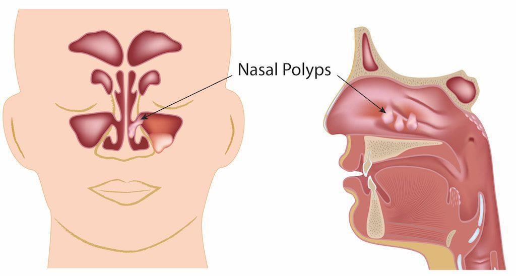 Nasal Obstruction Symptoms, Causes, Treatment - Fort Worth ENT